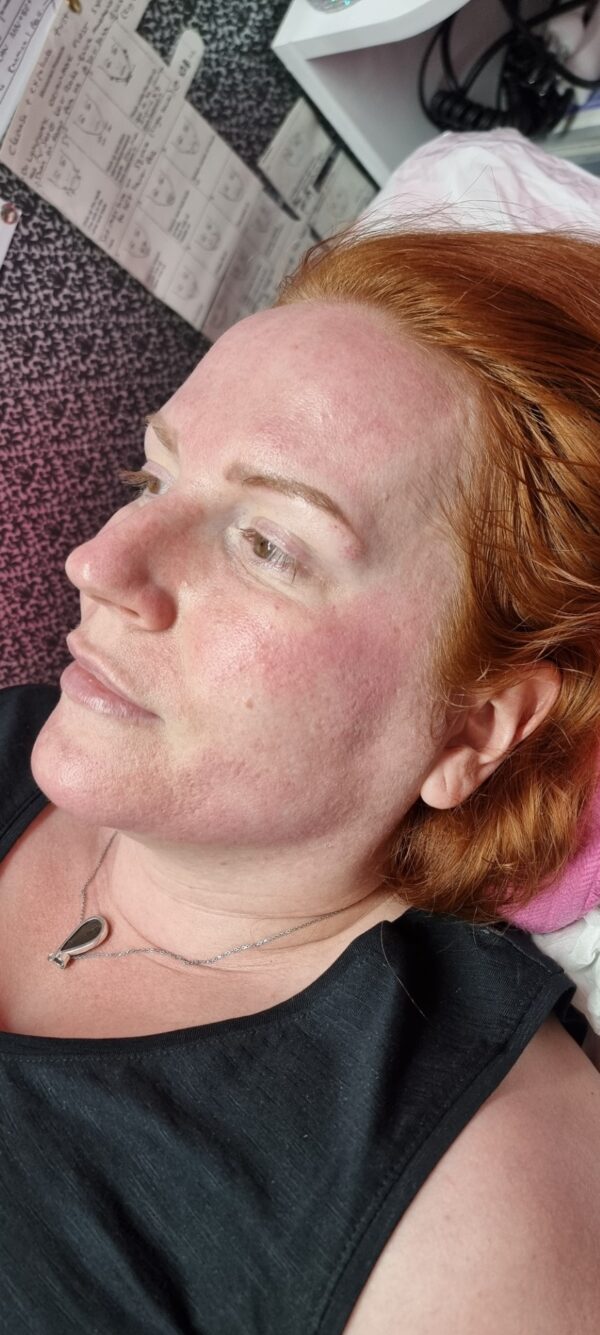 Editable Microneedling Course Manual