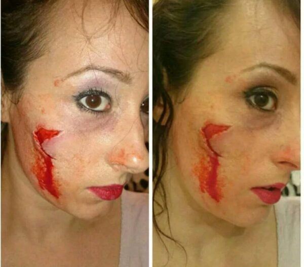 2 small sharp cheek wound injury